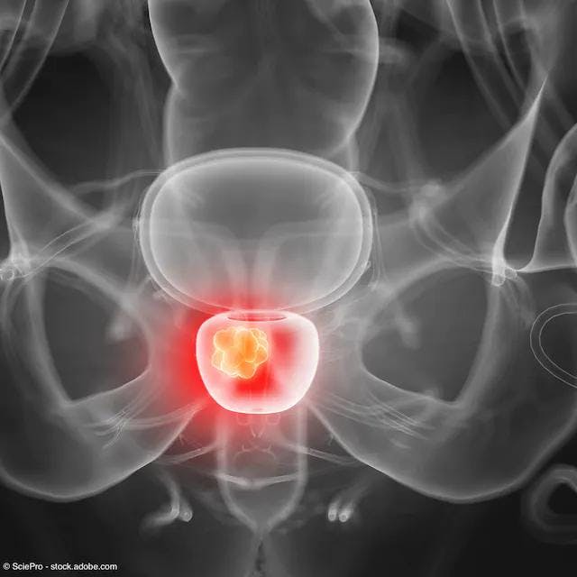 medical depiction of prostate cancer on xray