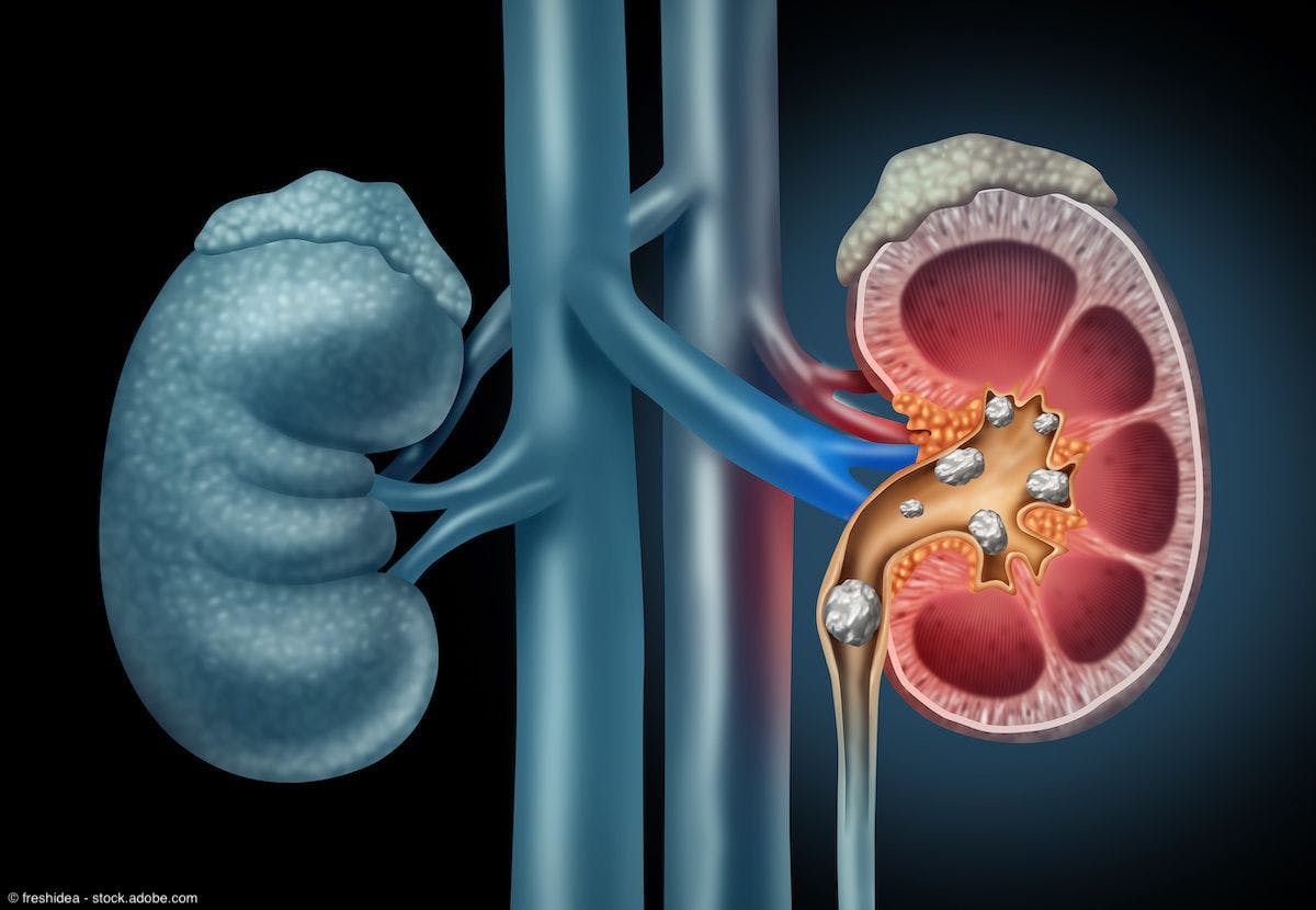 medical depiction of kidney stones
